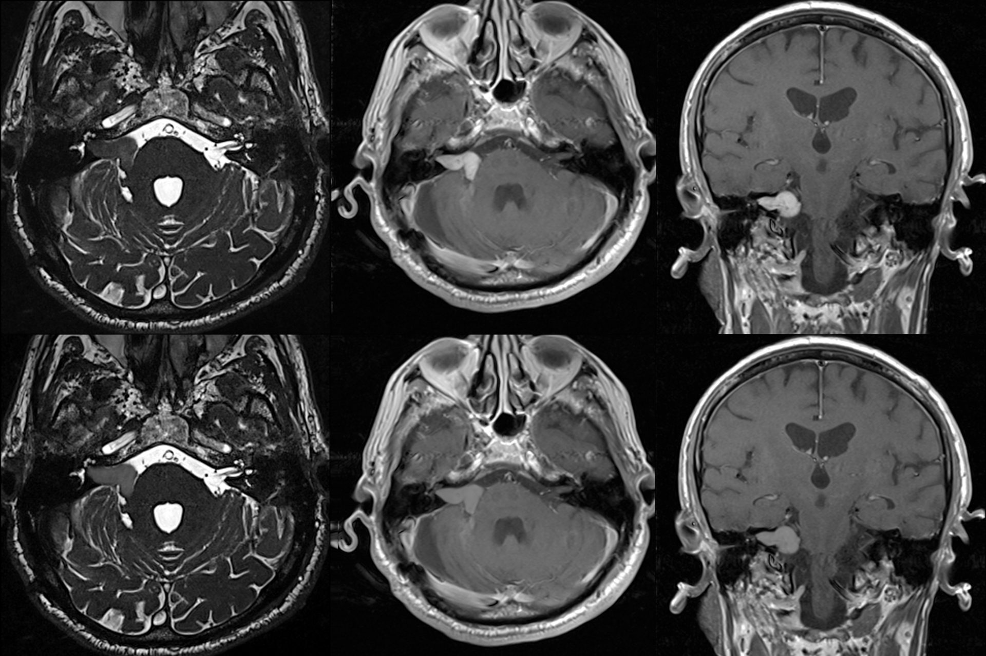 IVRT® - Akustikusneurinom: Symptome, Diagnose & Behandlung